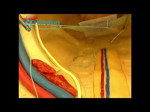 Laparoscopic Urogynaecology Training - Pectopexy and Colpopexy