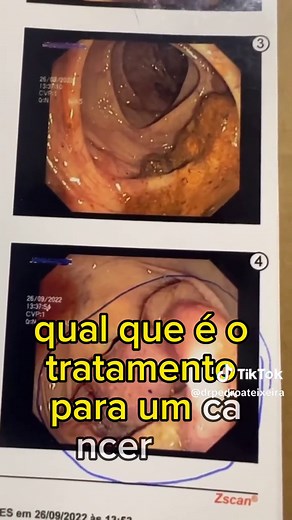 Colonoscopia: identificando câncer de intestino. Diverticulox diverticulite #CapCut