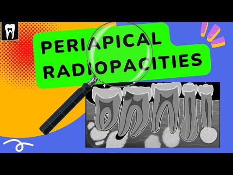 Periapical lesions | Periapical radiopacities | Oral radiology| Apical radiopacities