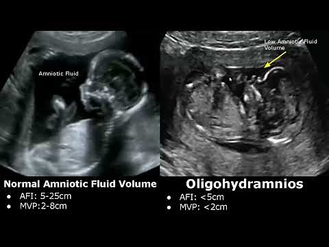 Amniotic Fluid Volume Ultrasound Normal Vs Abnormal | Oligohydramnios/Polyhydramnios | AFP/MVP USG