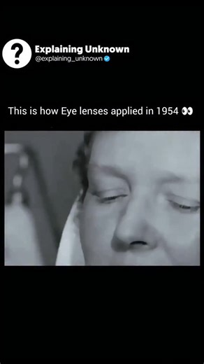 Explaining Unknown on Instagram: "In 1954, eye care was a far cry from what we know today. Without modern contact lenses or strict hygiene standards, practitioners applied eye lenses by hand, accepting discomfort and risk as part of the process. This rare footage captures a pivotal moment in medical history—one that reminds us how far eye care has evolved, and how these early practices paved the way for the safe, advanced treatments we rely on now."