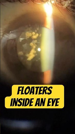 Floaters in the eye. #floaters #eyes