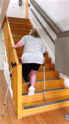 Jennifer Using a Below-Knee Osseointegration Prosthesis
