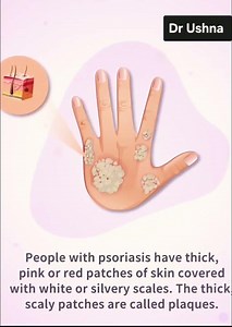 🔥 Psoriasis Explained in 60 Seconds | Signs, Causes & Treatment #Shorts