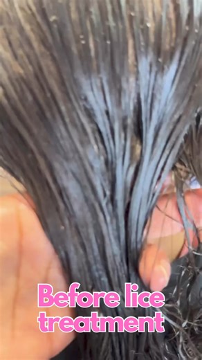 17K views · 32 reactions | Treating a client for lice l why I hate over the counter lice products #explore #hair #momlife #piojos #lice | Stacey The Louse Lady | Facebook