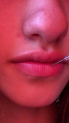 Cosmetic Procedure: Lip Enhancement Insights