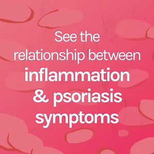 When inflammation occurs, it can lead to plaques on the skin. Learn what’s behind the buildup. | psoriasisSPEAKS