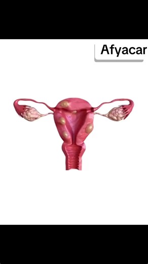 Signs and Symptoms of Uterine Fibroids Explained