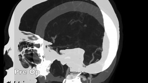 Dural Arteriovenous Fistula 387B