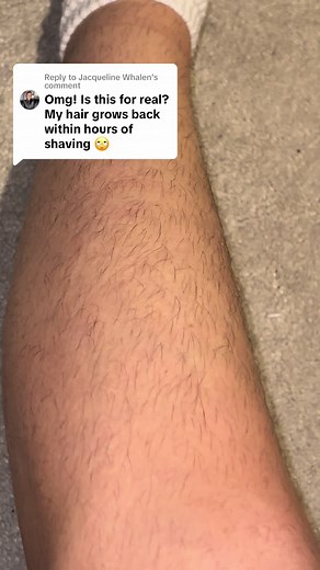 Leg Hair Growth Challenges Addressed with Dermaplaning
