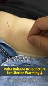 In Pulse Balance Acupuncture, the Shaosanhuo technique applied to Guanyuan (CV4) is a highly effective uterine warming therapy. This method generates heat that penetrates deeply, warming the uterus, enhancing blood circulation, and improving overall uterine health. Patients often describe a soothing warmth radiating from the lower abdomen to the uterus, bringing immense comfort and relieving menstrual discomfort. Why opt for Pulse Balance Acupuncture for uterine warming? • Dispels Cold, Warms Ya