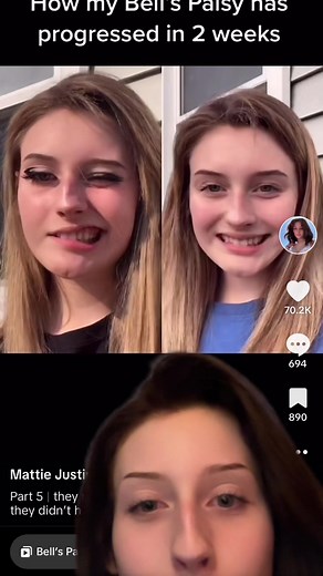 Bell's Palsy Recovery Journey: My Experience in Video