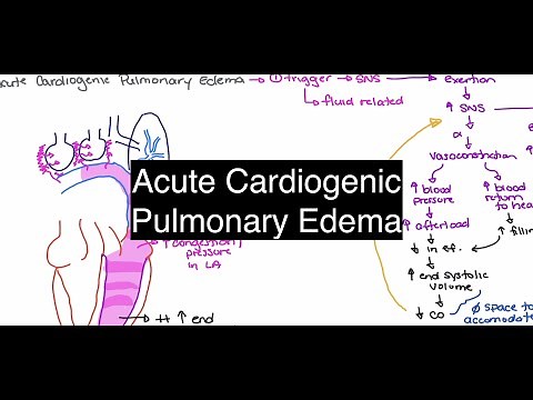 Acute Cardiogenic Pulmonary Edema