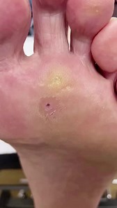 Discover the mystique behind corns Unveil the journey now! . . . #footpain #plantarfasciitis #heelpain #podiatry #footcare #podiatrist #orthotics #feet #foothealth #kneepain #foot #running #anklepain #backpain #bunions #flatfeet #healthyfeet #footpainrelief #arthritis #health #footdoctor #bunion #fyp #foryou #viralreels #explorereels | Docpods Treatment