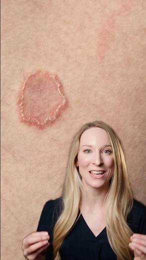 Ringworm is a fungal infection and is contagious! #ringworm #dermatologist #fungus #skincare