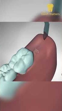 Wisdom Tooth Extraction & Nerve Risks: What You Need to Know! 🦷 #smartphone