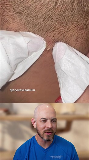 Large pimple extraction on the back of the head. #satisfying #pimplepop