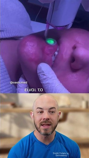 Laser Treatment for a Chin and Lip Port Wine Stain