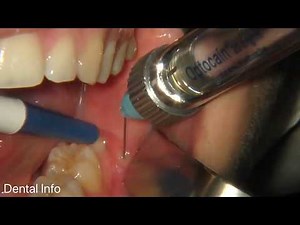 Semi-Impacted Wisdom Tooth Removal | Step By Step