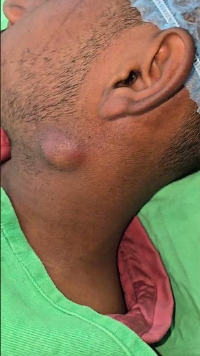 Sebaceous cyst infection