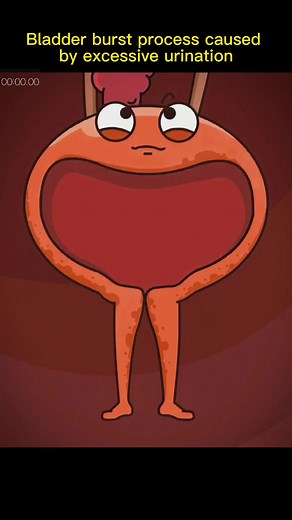 #excessive #urination #bladder #burst #foryou #fyp | bladder look like