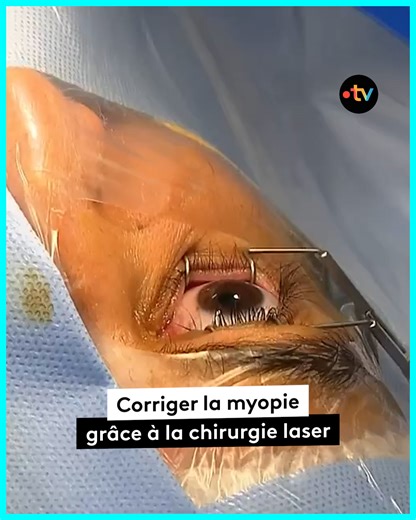 L'opération au laser d'une myopie | Allo Docteurs - Le Mag de la Santé