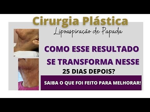Antes e depois Lipo de papada: resultado imediato, fibroses, tratamento, drenagem pós-operatório!
