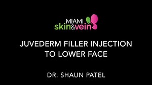 The Doctor Demonstrates Juvederm Injections for Smile Lines, Marionette Lines, and Prejowl Lines