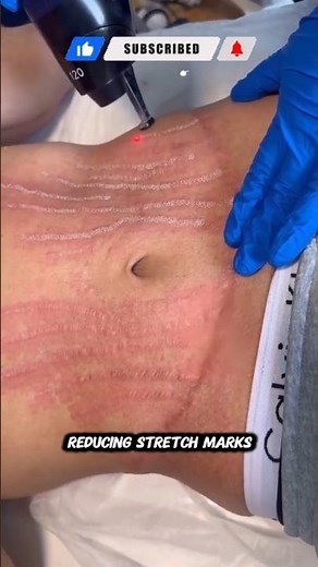 Stretch Marks Don’t Stand a Chance With This Skin Treatment