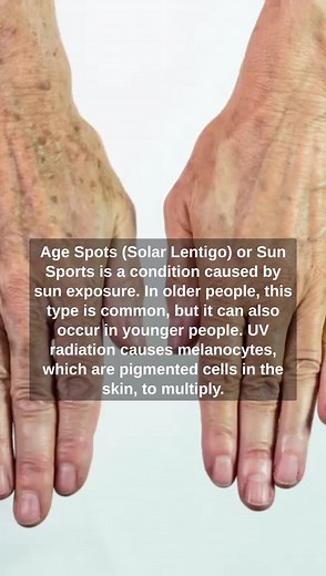Age Spots (Solar Lentigo) or Sun Sports is a condition caused by sun exposure. In older people, this type is common, but it can also occur in younger people. UV radiation causes melanocytes, which are pigmented cells in the skin, to multiply. Affected areas include the face, hands, shoulders, and arms, all exposed to the sun. Over time, the spots may become more prominent. Some people refer to solar lentigines as liver spots or sunspots. Such concerns are not available to be treated by doctors u