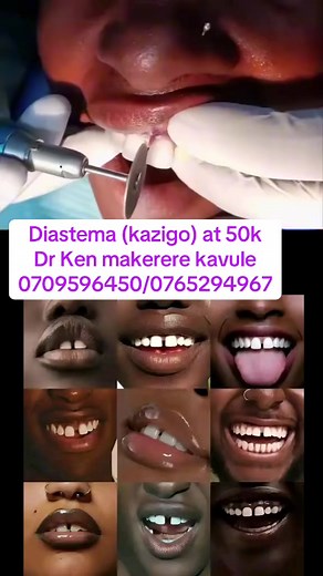 Diastema (kazigo) treatment cost 50k — Dr Ken Makerere Kavule contact