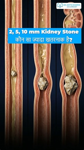 2 vs 5 vs 10mm Kidney Stone – Which Is Most Dangerous? | 2, 5 या 10mm स्टोन – सबसे खतरनाक कौन?