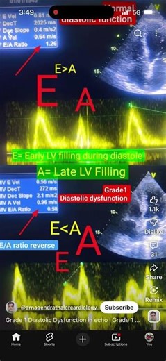Grade 1 diastolic dysfunction # PW at mitral valves
