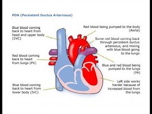Clinical features of Patent ductus arteriosus Signs and symptoms