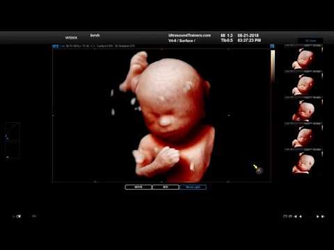 Samsung WS80a Ultrasound with HD Demo