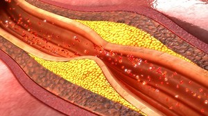 Athérectomie : principe, indications, complications, suivi médical