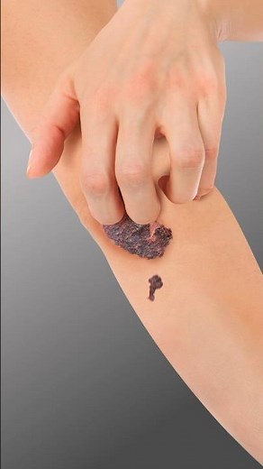 ¿Qué pasa si te arrancas una costra?