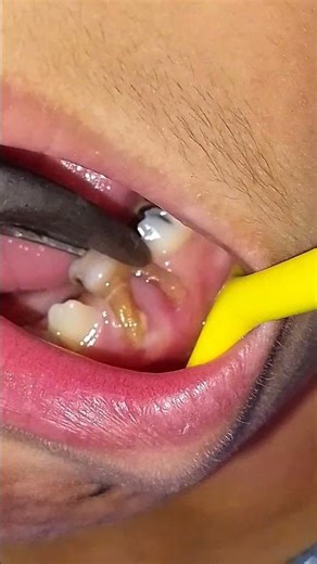 Extraction of Primary (Baby) Tooth in Children