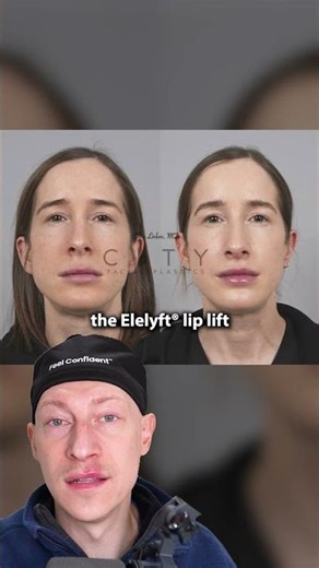 Bullhorn Lip Lift | Plastic Surgeon Reacts