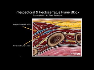 Truncal Regional Anesthesia: From Pecs to Pelvis: A Complete Guide to Truncal Blocks