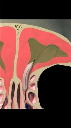 What is Balloon Sinuplasty? #balloonsinuplasty #entcare
