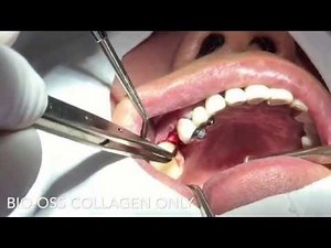 Ridge preservation - BioOss Collagen only No membrane coverage