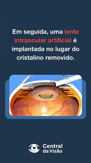 👀 What is cataract surgery really like?