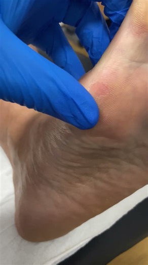 Transform Your Feet: Bunion & Callus Removal at the Podiatry Clinic #FootCare #Podiatry