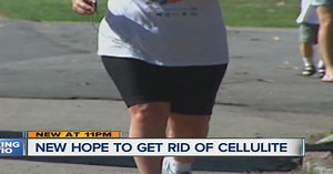 New treatment may help get rid of cellulite