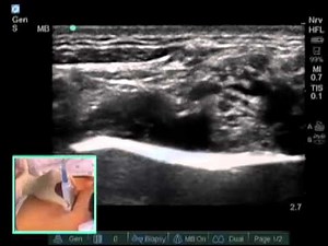 ULTRASOUND-GUIDED SUPRACLAVICULAR NERVE BLOCK