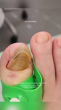 Thick nails causing you trouble? 👣 by Miss Foot Fixer Marion Yau