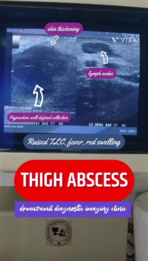 Thigh Abscess in a patient with raised TLC, fever, and red swelling in thigh. #thigh #abscess #fever #tlc #swelling #ultrasound