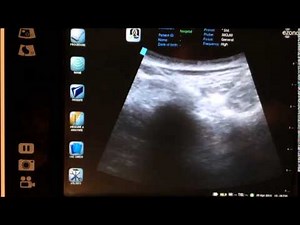 ultrasound guided bilateral SI joint injection ( sacroilliac joint injection)