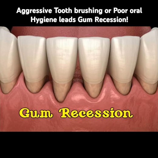 "Understanding Gum Recession: Causes, Prevention, and Treatment Options"
